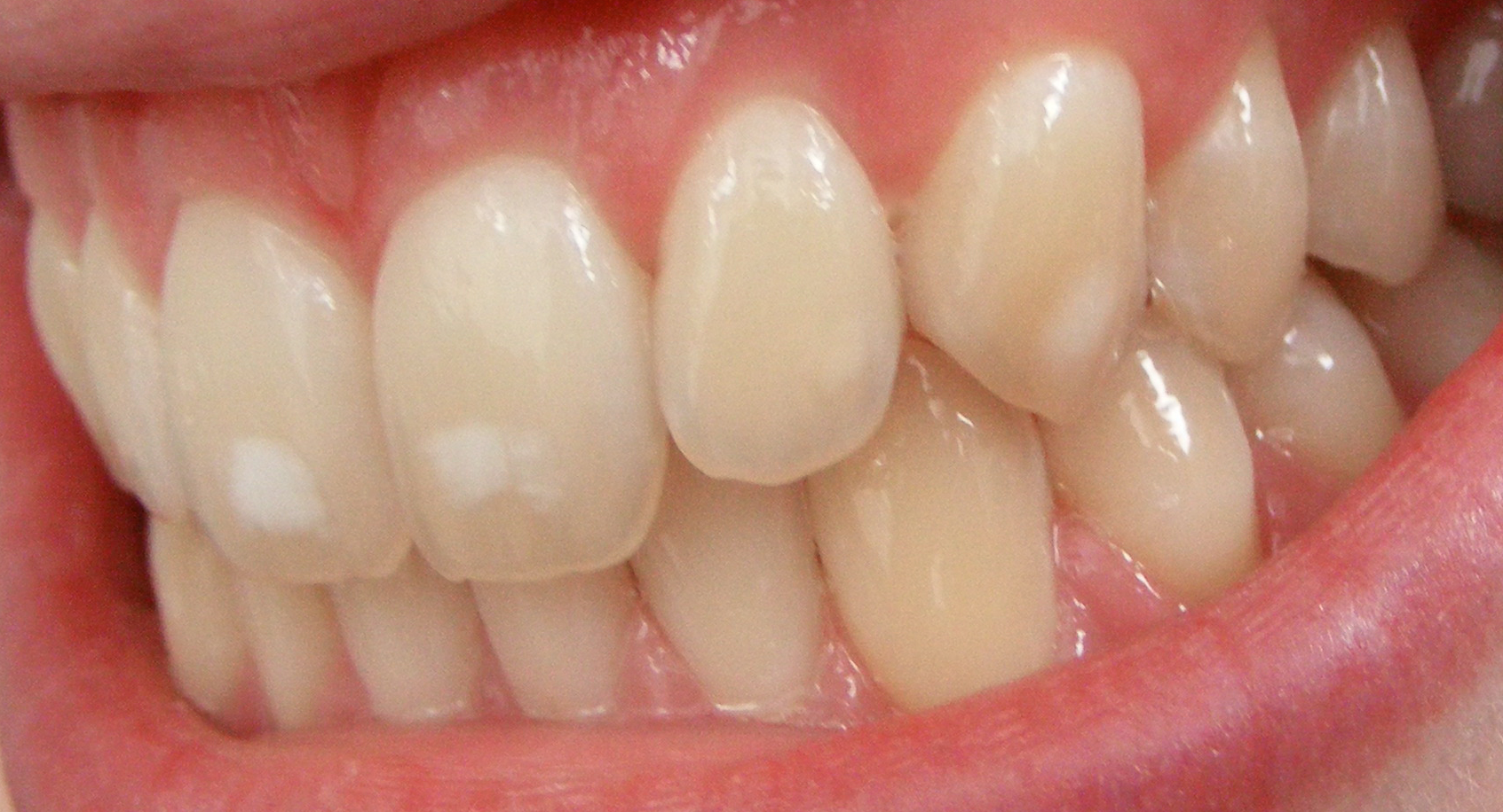 Dental_fluorosis_(mild)