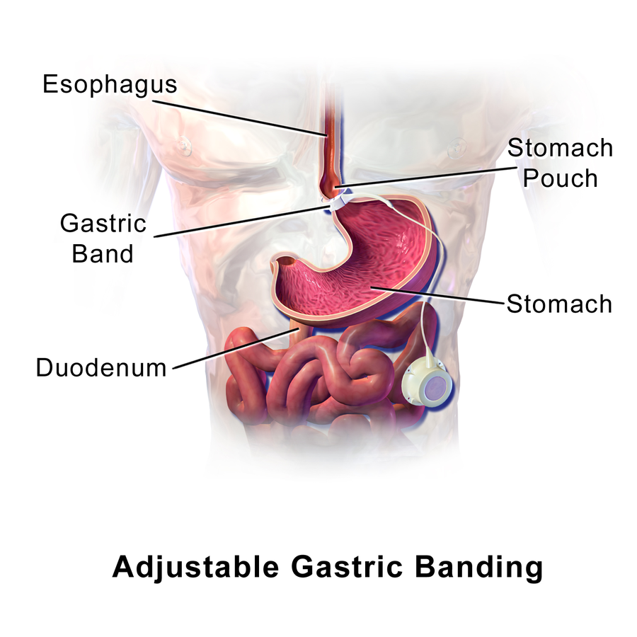 The Weight Loss Sleeve can help manage your appetite